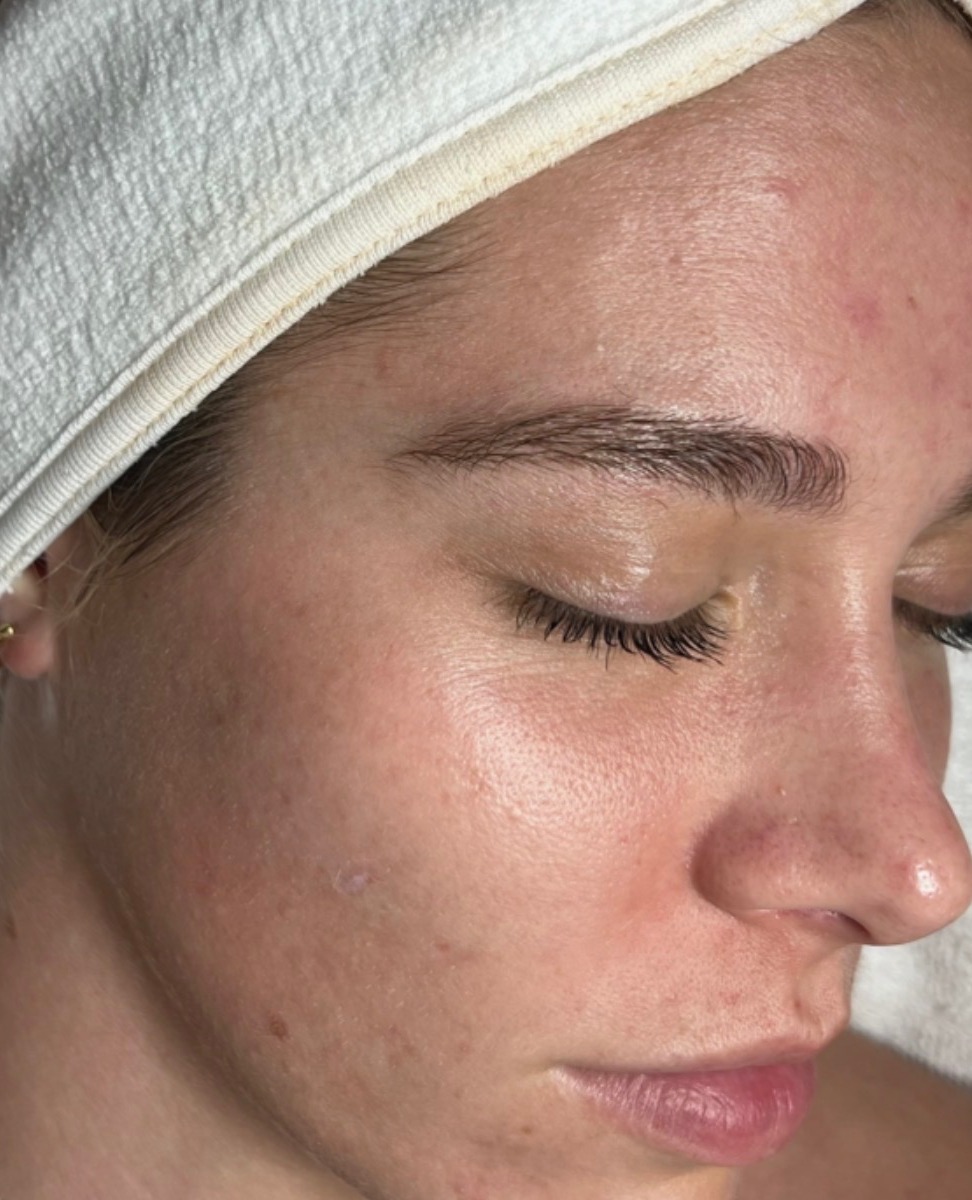 Client skin after treatment: calmer, clearer skin with light residual marks