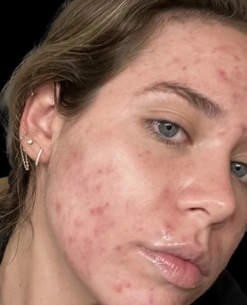 Client skin before treatment: active breakouts and redness across the cheek, jaw and forehead